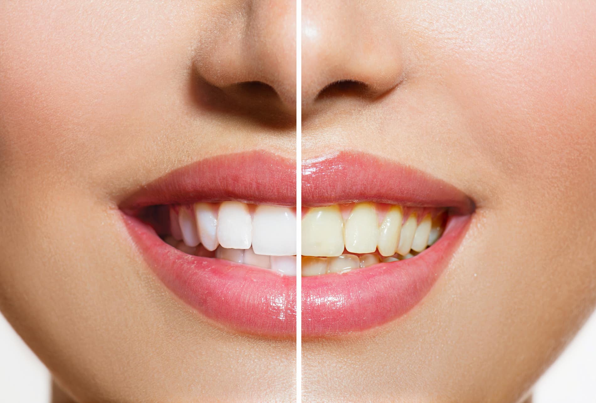 Teeth whitening results at Clarity Dental Group