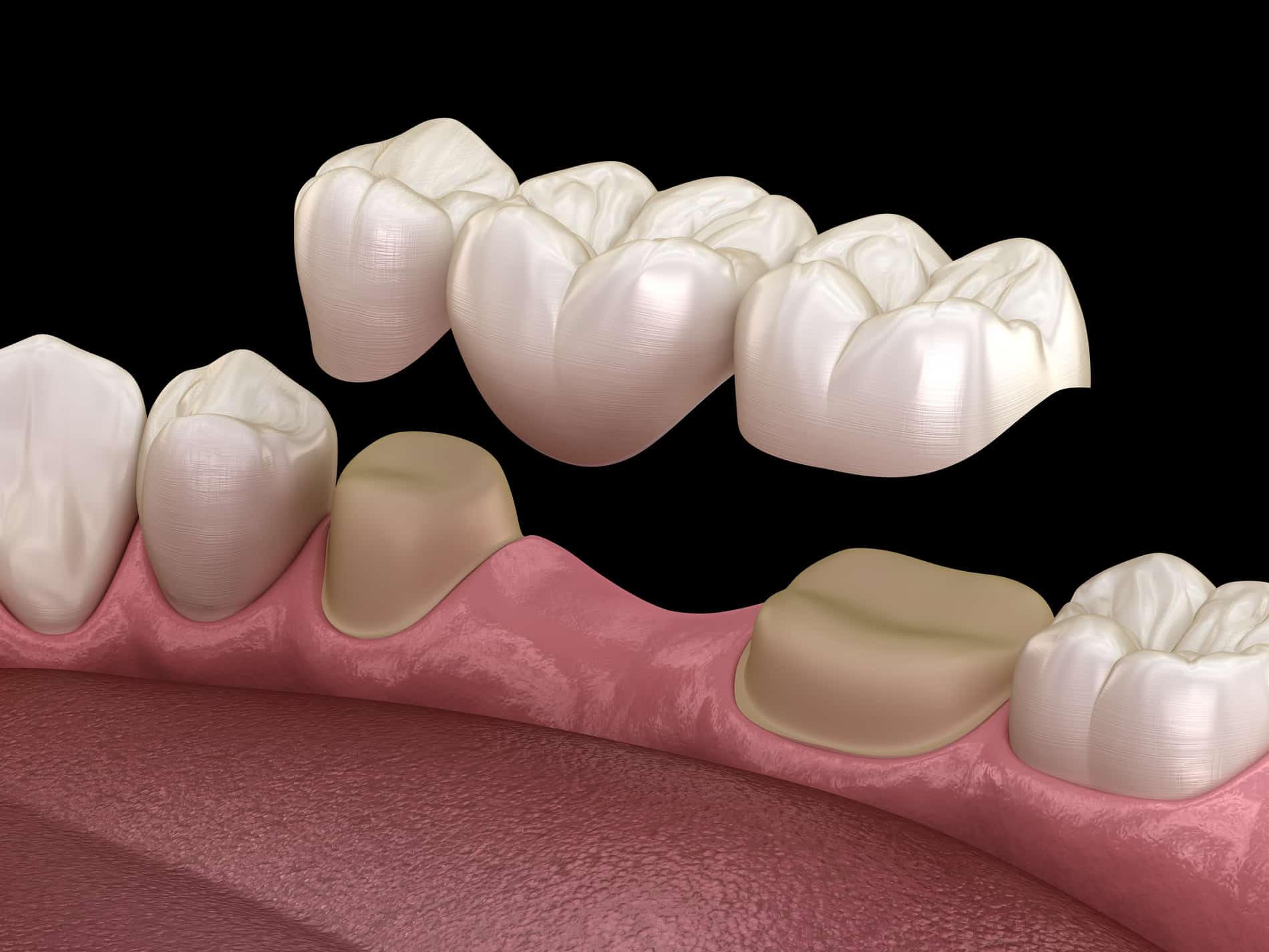 Model of a dental bridge ay Clarity Dental Group in Lindenhurst IL