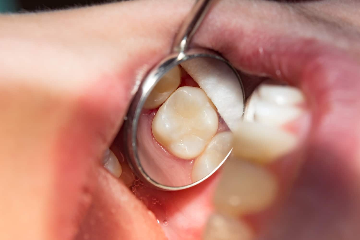 Patient's tooth colored filling at Clarity Dental Group in Lindenhurst IL