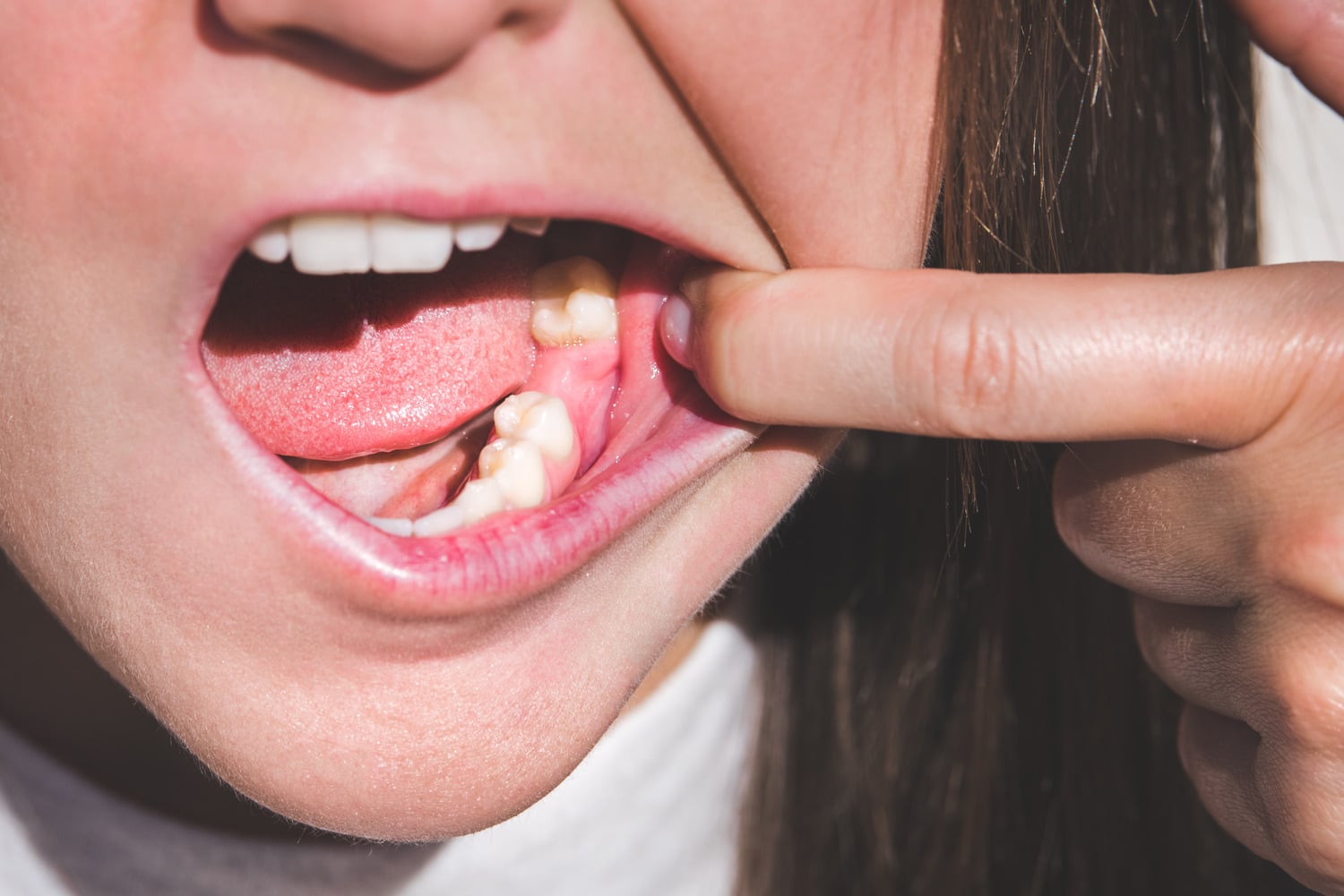 Woma shows off her missing tooth after a Tooth Extractions in Lindenhurst, IL