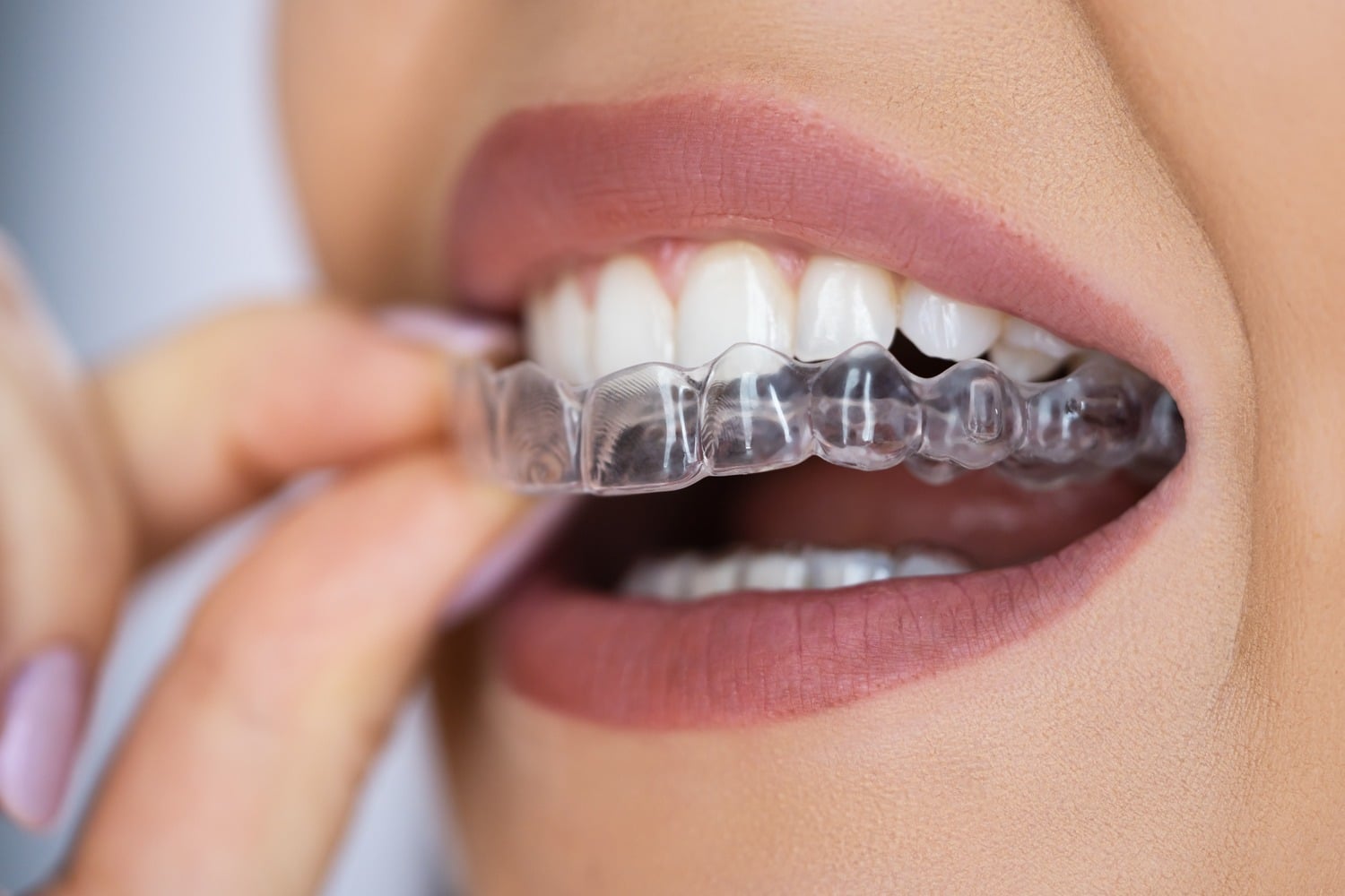 Invisable aligner treatment in Lindenhurst IL